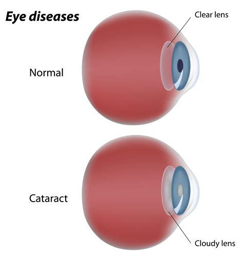 eye test for cataracts chart